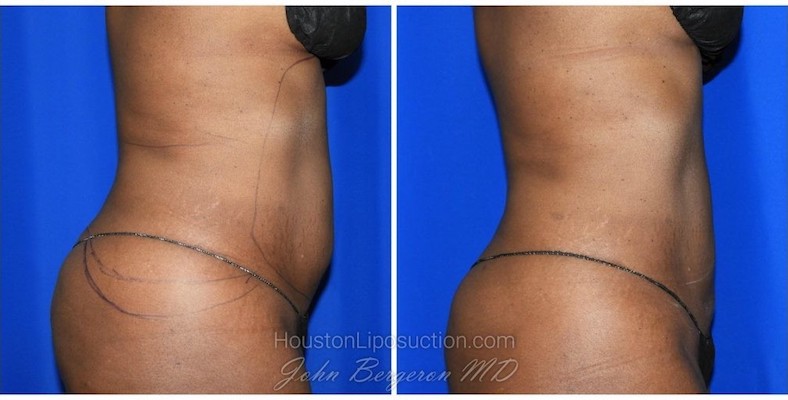 Hip Dip Liposuction - Houston Lipo Center