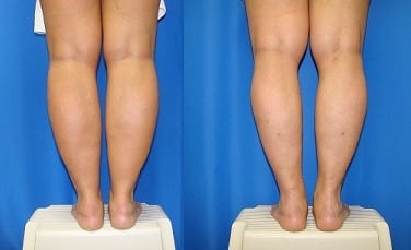 SmartLipo for your Calves and Ankles - Bergeron, John ...