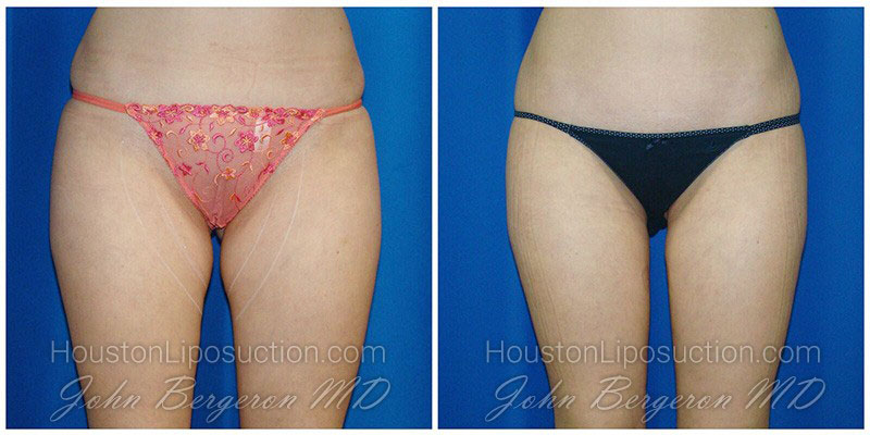 Thigh & Knee Liposuction / Houston Lipo Center