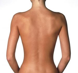 Back Liposuction / Houston Lipo Center