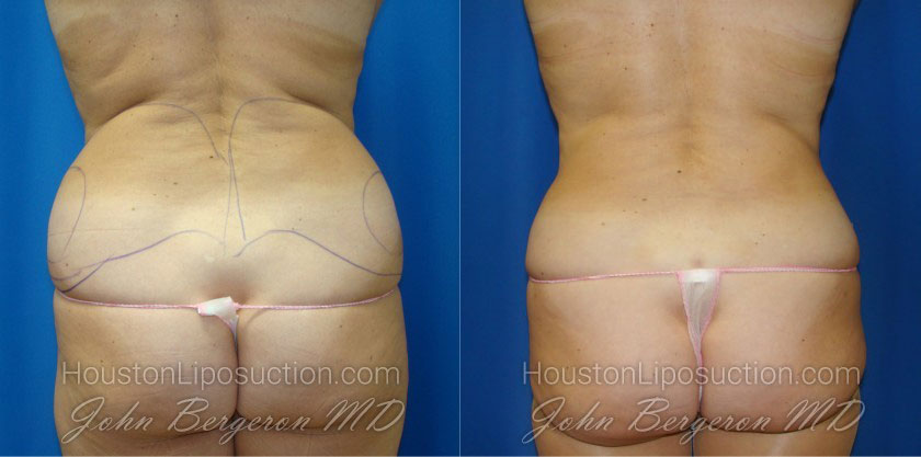 Hip Dip Liposuction - Houston Lipo Center