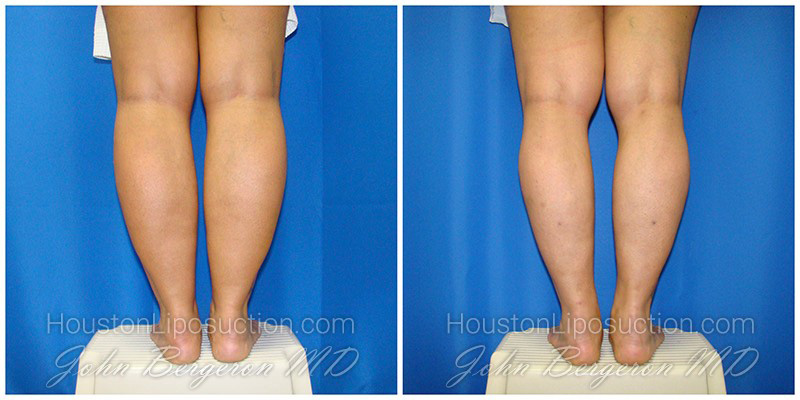 liposuction recovery