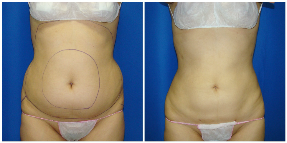How Does Tummy or Abdominal Liposuction Work?