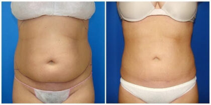 stomach liposuction lipo