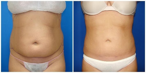 How This AirSculpt® Patient Got A Flatter Stomach and Curvier Hips