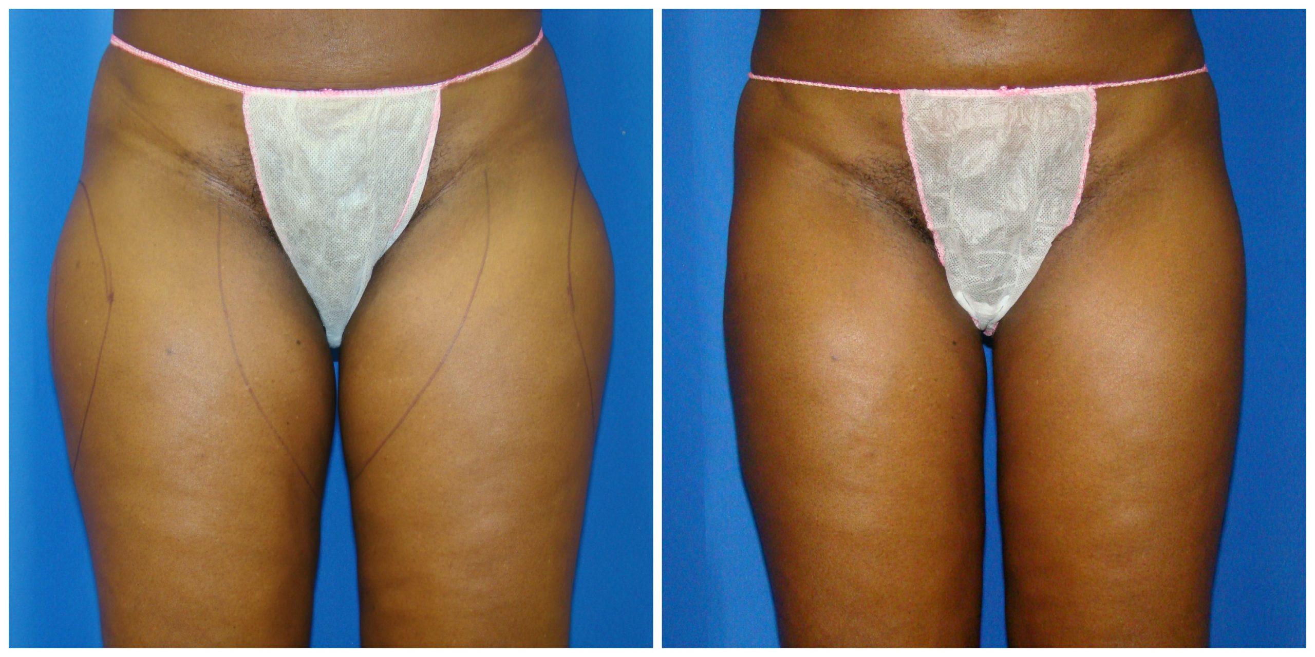 Post Leg Liposuction Recovery Surgical High