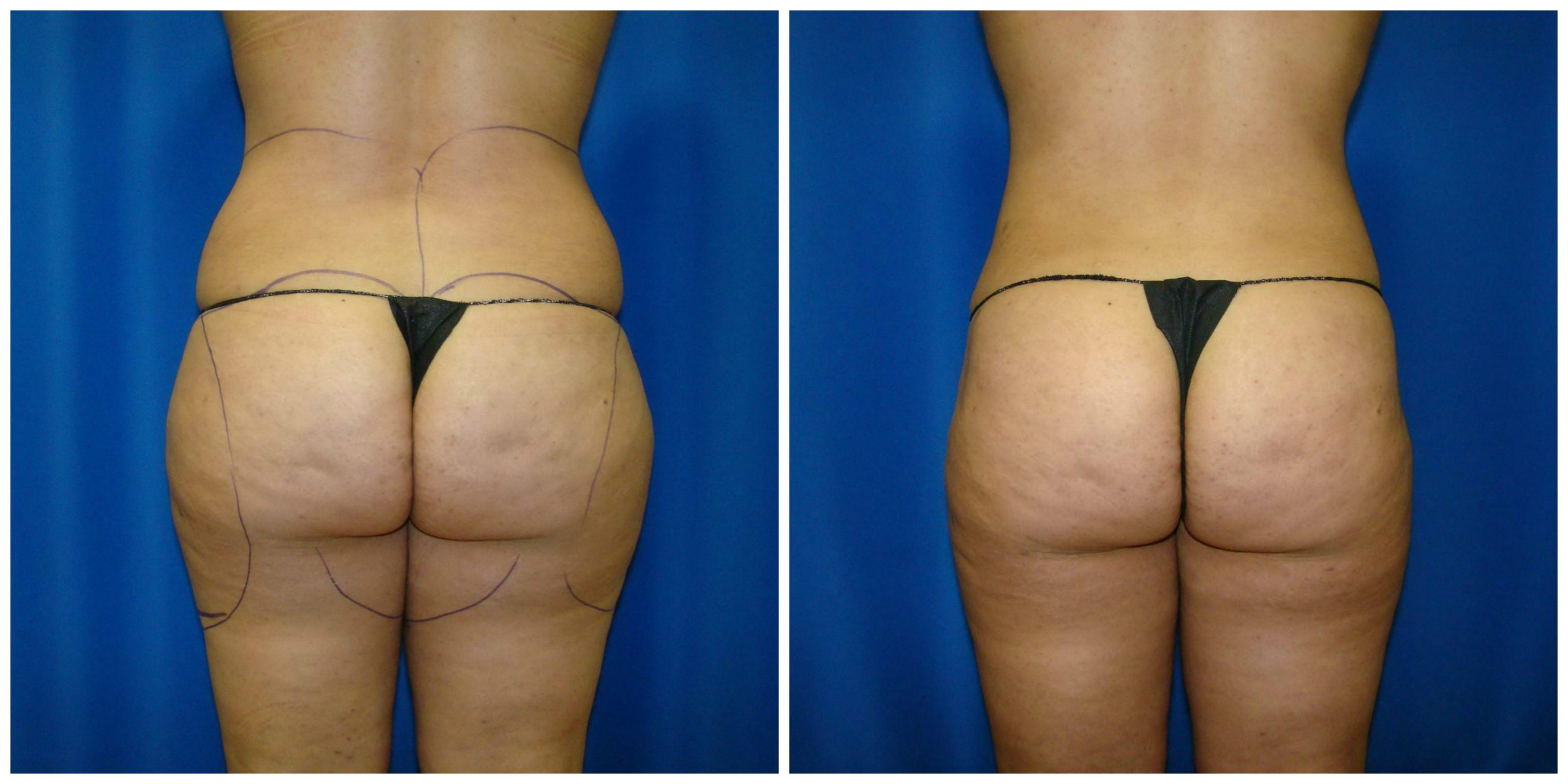 4 Tips to Recover from Liposuction