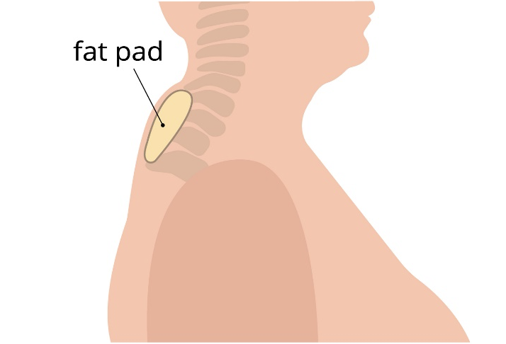 What Exactly is a Dorsocervical Fat Pad?