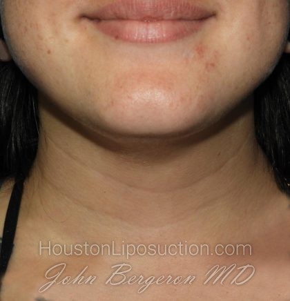 Liposuction Before & After Patient #3412