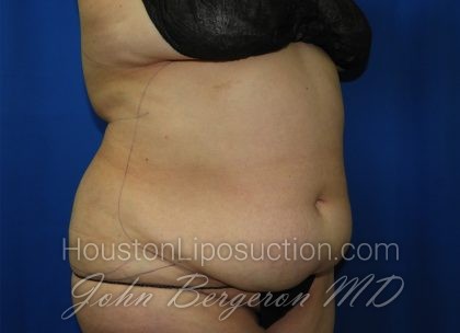 Liposuction Before & After Patient #3428