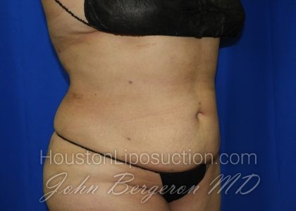 Liposuction Before & After Patient #3428