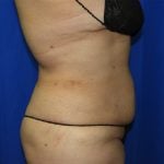 Liposuction Before & After Patient #3428