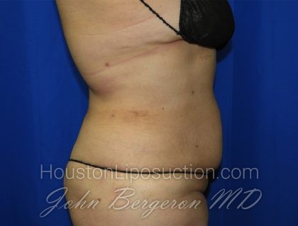 Liposuction Before & After Patient #3428