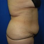 Liposuction Before & After Patient #3428