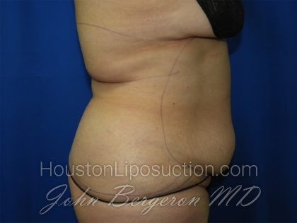 Liposuction Before & After Patient #3428