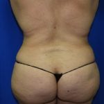 Liposuction Before & After Patient #3428