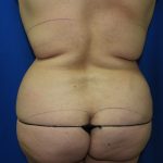 Liposuction Before & After Patient #3428