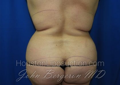 Liposuction Before & After Patient #3428