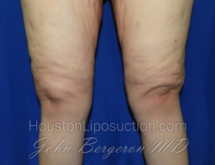 Liposuction Before & After Patient #3438