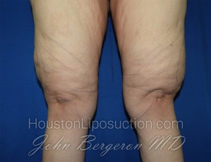 Liposuction Before & After Patient #3438