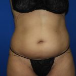 Liposuction Before & After Patient #3447