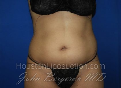 Liposuction Before & After Patient #3447