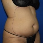 Liposuction Before & After Patient #3447