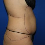 Liposuction Before & After Patient #3447