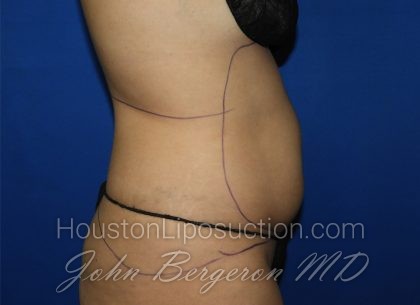 Liposuction Before & After Patient #3447