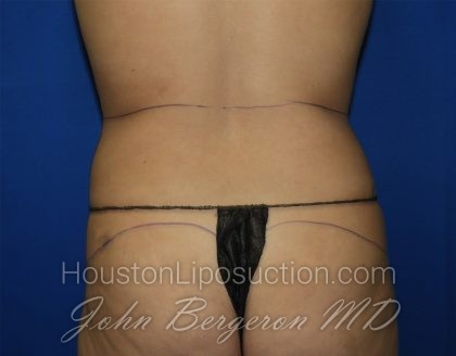 Liposuction Before & After Patient #3447