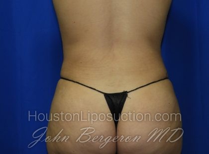 Liposuction Before & After Patient #3447