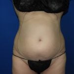 Liposuction Before & After Patient #3463