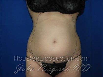 Liposuction Before & After Patient #3463