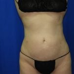 Liposuction Before & After Patient #3463