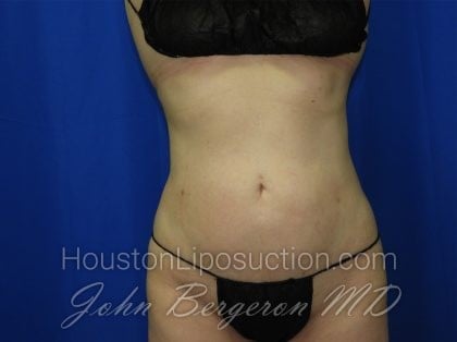 Liposuction Before & After Patient #3463