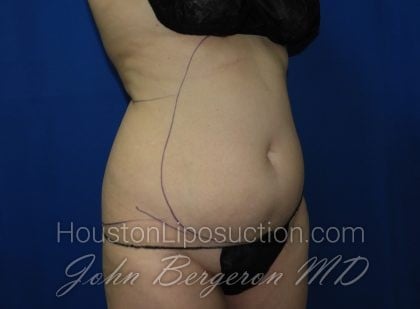 Liposuction Before & After Patient #3463