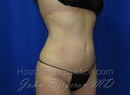 Liposuction Before & After Patient #3463