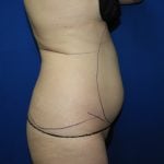 Liposuction Before & After Patient #3463