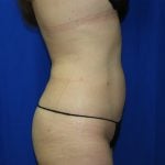 Liposuction Before & After Patient #3463