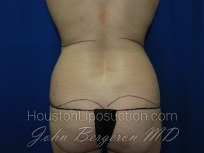 Liposuction Before & After Patient #3463